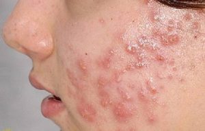 Mẹo Chăm Sóc Da Mụn Mủ Ở Da Khô Hiệu Quả Chuẩn Y Khoa