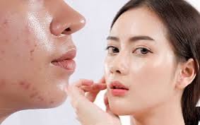  5 Mẹo Chăm Sóc Da Mụn Đầu Đen Cho Da Dầu Vào Mùa Hè