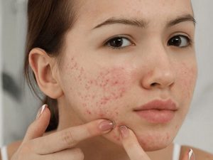 Top 6 Cách Chăm Sóc Da Mụn Tuổi Dậy Thì An Toàn, Hiệu Quả Chuẩn Y Khoa Tại Nhà