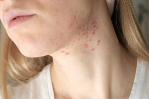 Mụn Mủ Ở Da Khô Hiệu Quả Chuẩn Y Khoa Không Để Lại Thâm Sẹo Sau 7 Ngày