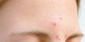 Cách Chăm Sóc Mụn Mủ Da Khô Ở Trán Tại Nhà Không Để Lại Thâm Sẹo