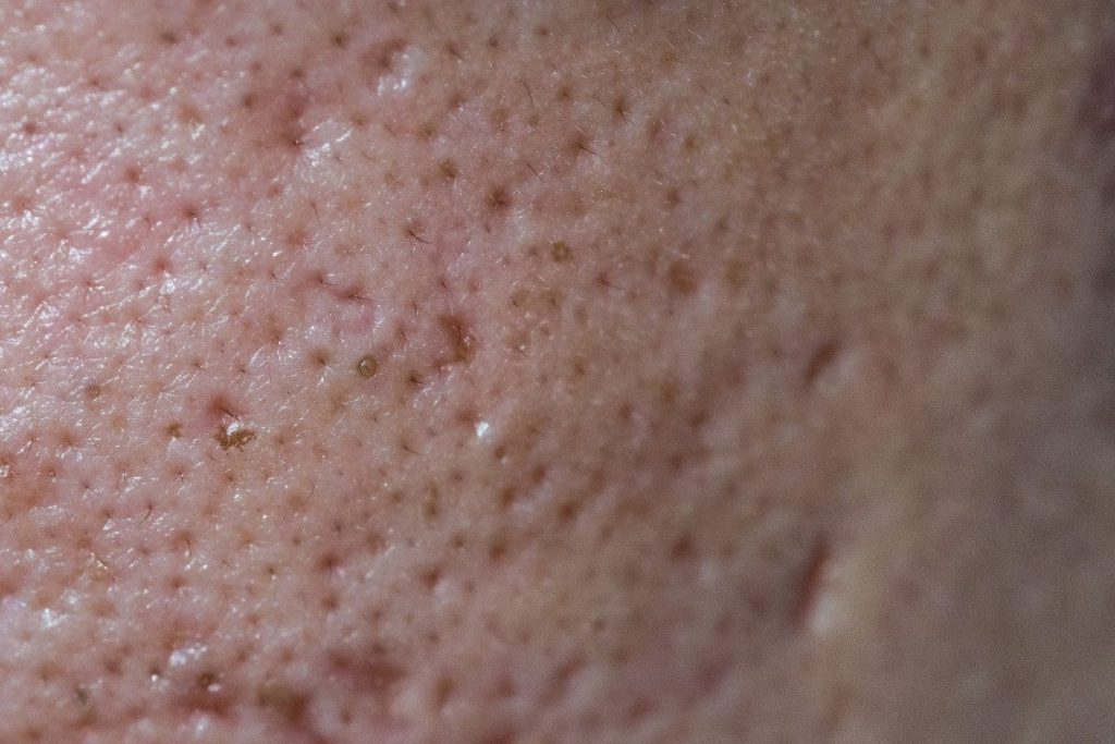 Chăm sóc da mụn lỗ chân lông to đúng cách chuẩn y khoa giúp bạn tự tin