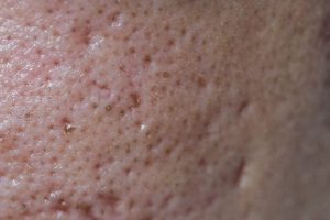 Chăm Sóc Da Mụn Lỗ Chân Lông To Đúng Cách Chuẩn Y Khoa