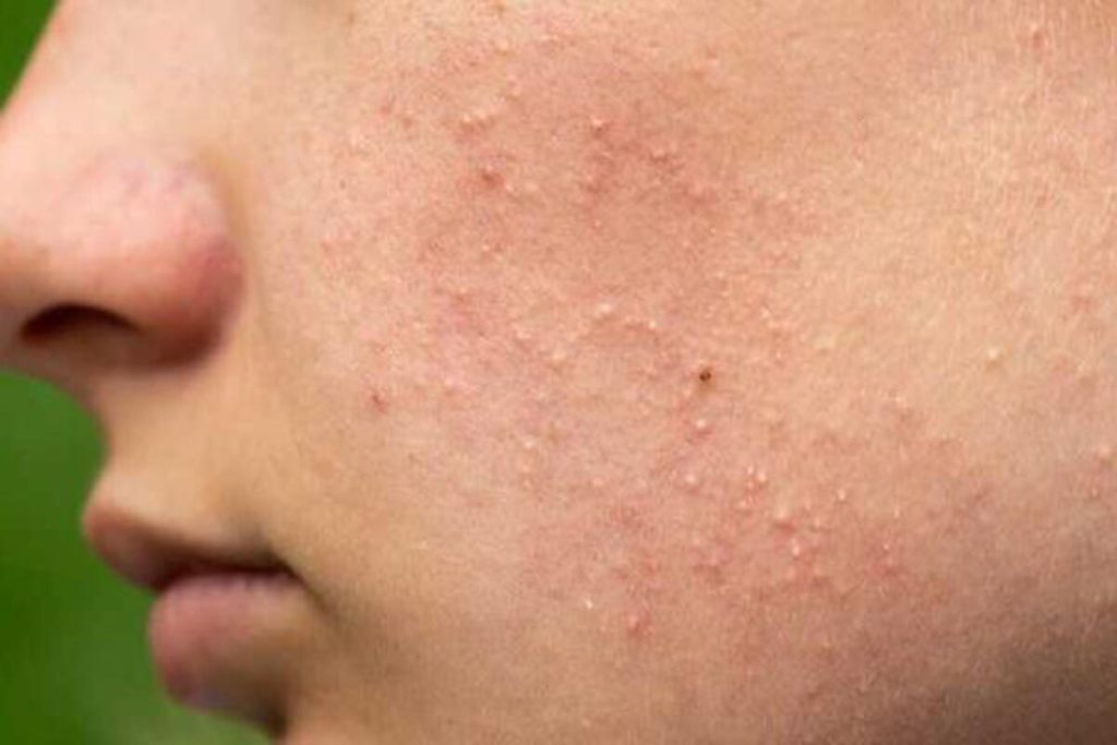 Điều Trị Mụn Ẩn Trên Da Mặt Đơn Giãn, Sạch Mụn, Hiệu Quả Tại Nhà 7 Nhà