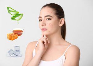 Cách Điều Trị Mụn Ở Quai Hàm Dễ Dàng, Thực Hiện Hiệu Quả Sau 1 Tuần